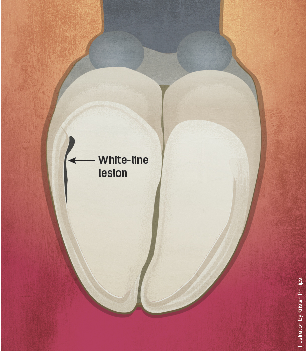 White-line lesion